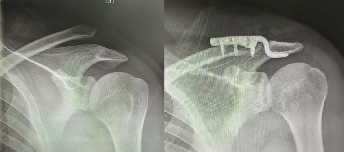 肩锁关节脱位治疗,肩锁关节脱位