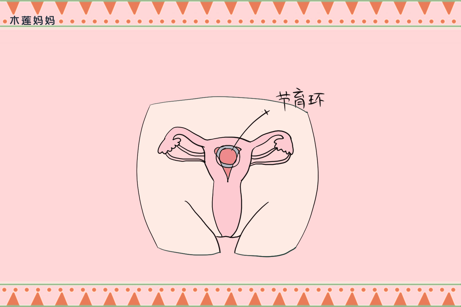 月嫂：用节育环20几年，取出时不亚于生一个孩子，太遭罪