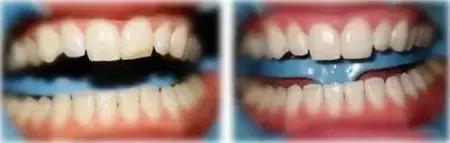 嘎嘣脆的牙齿,牙齿碎裂因为什么