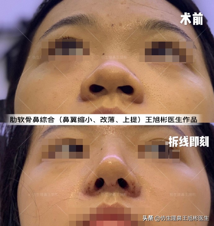 外切缩鼻翼的后遗症,外切鼻翼缩小会回弹吗