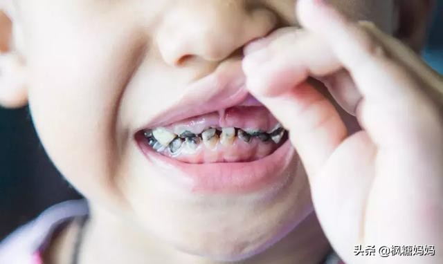 4岁儿童蛀牙有虫牙了怎么补救,4岁9个月孩子门牙蛀牙只剩根