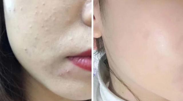 闭口反反复复长到底怎样才能根治,闭口反反复复长怎么办