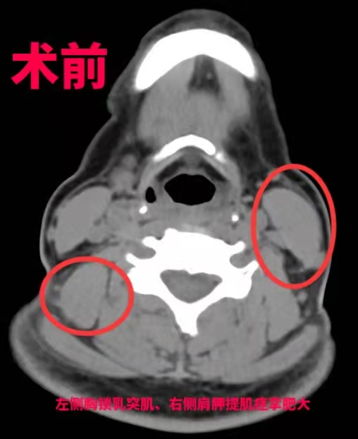 切断关键神经治疗“歪脖子”，广州专家找到全新根治性方案