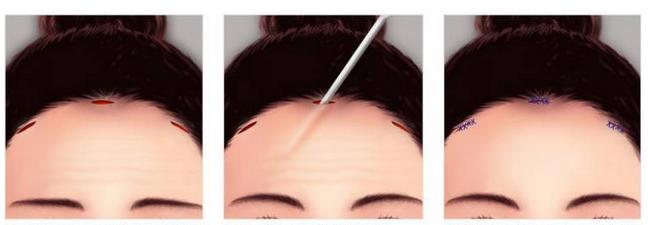 小切口拉皮除皱术适合额头除皱吗,额头缩小大拉皮手术恢复过程