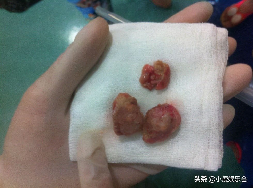 儿童扁桃体手术20天能正常吃饭吗,扁桃体腺样体手术7-15天亲身感受