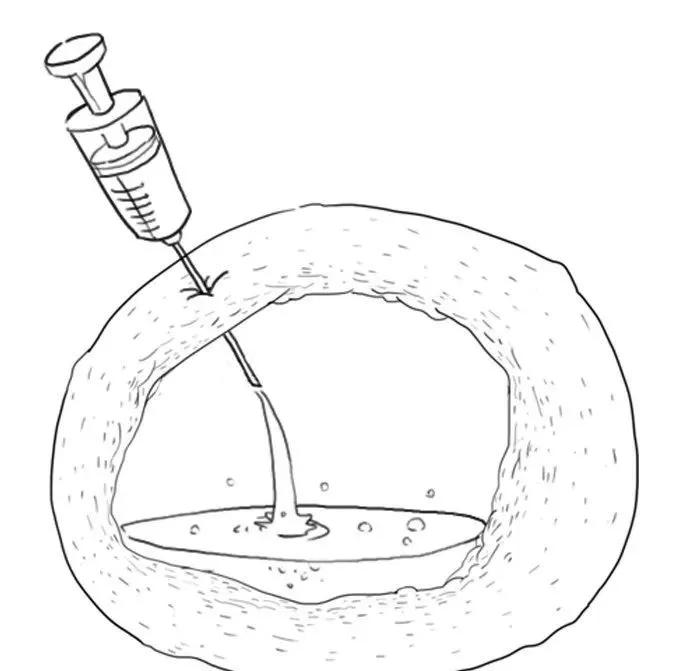 卵巢囊肿巧克力怎么形成的,卵巢长了巧克力囊肿是怎么回事
