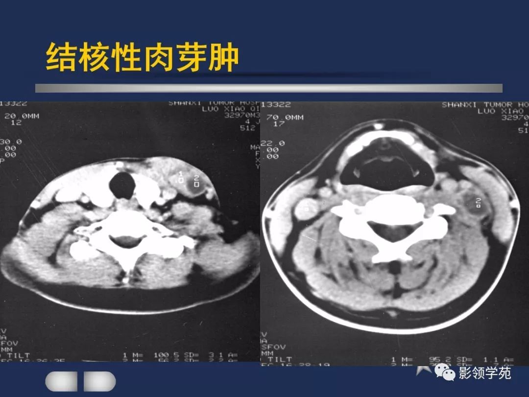 腮腺疾病影像学诊断,腮腺肿块影像诊断