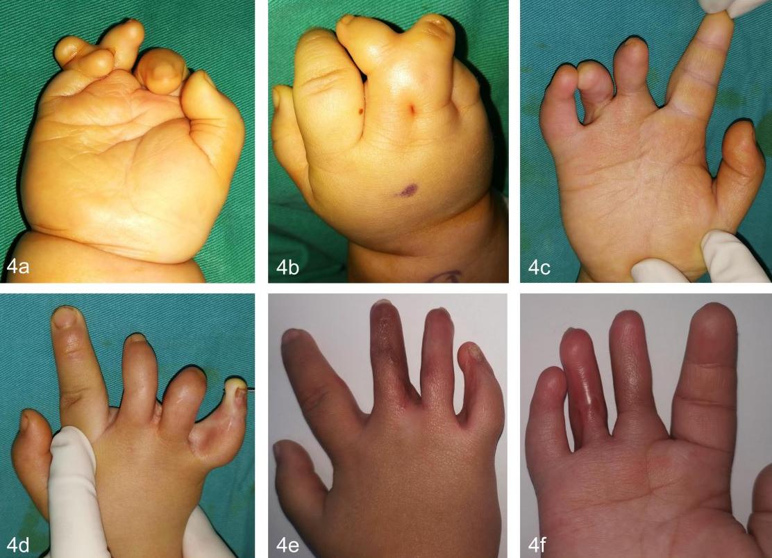 先天性并指畸形科普以及案例分享,先天性并指畸形