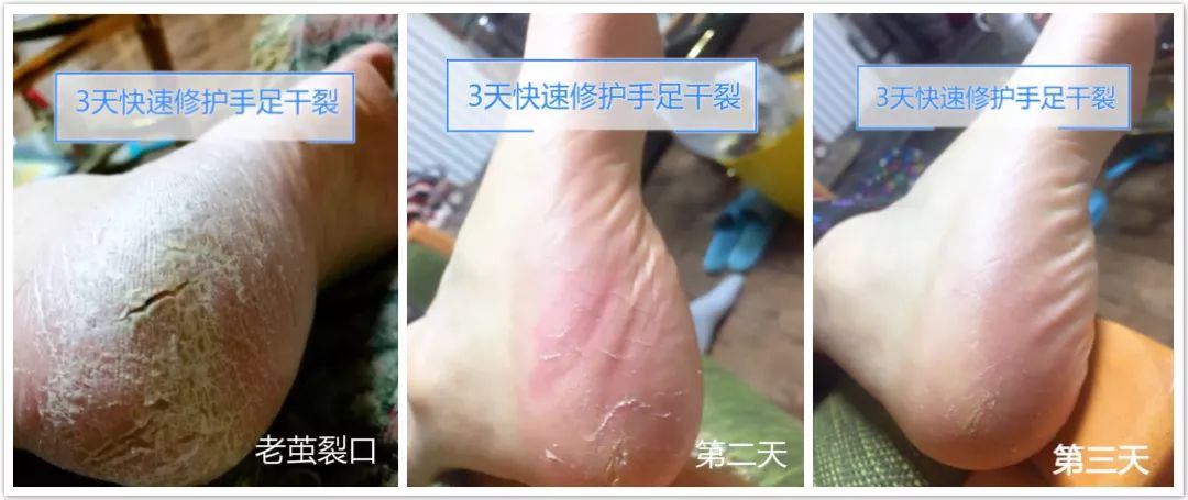冬天脚后跟干裂用什么润脚霜,润足脚后跟干裂修复霜