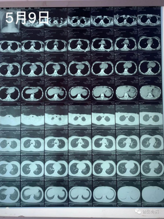 脂肪填充栓塞概率,脂肪填充栓塞几率