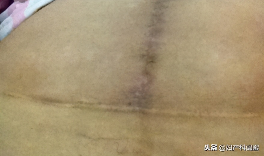 剖宫产横切口位置在耻骨,剖宫产切口憩室是指子宫的切口吗