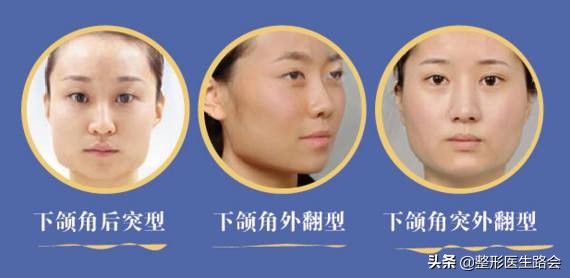 方脸国字脸下颌缘提升,方脸国字脸下颌骨宽