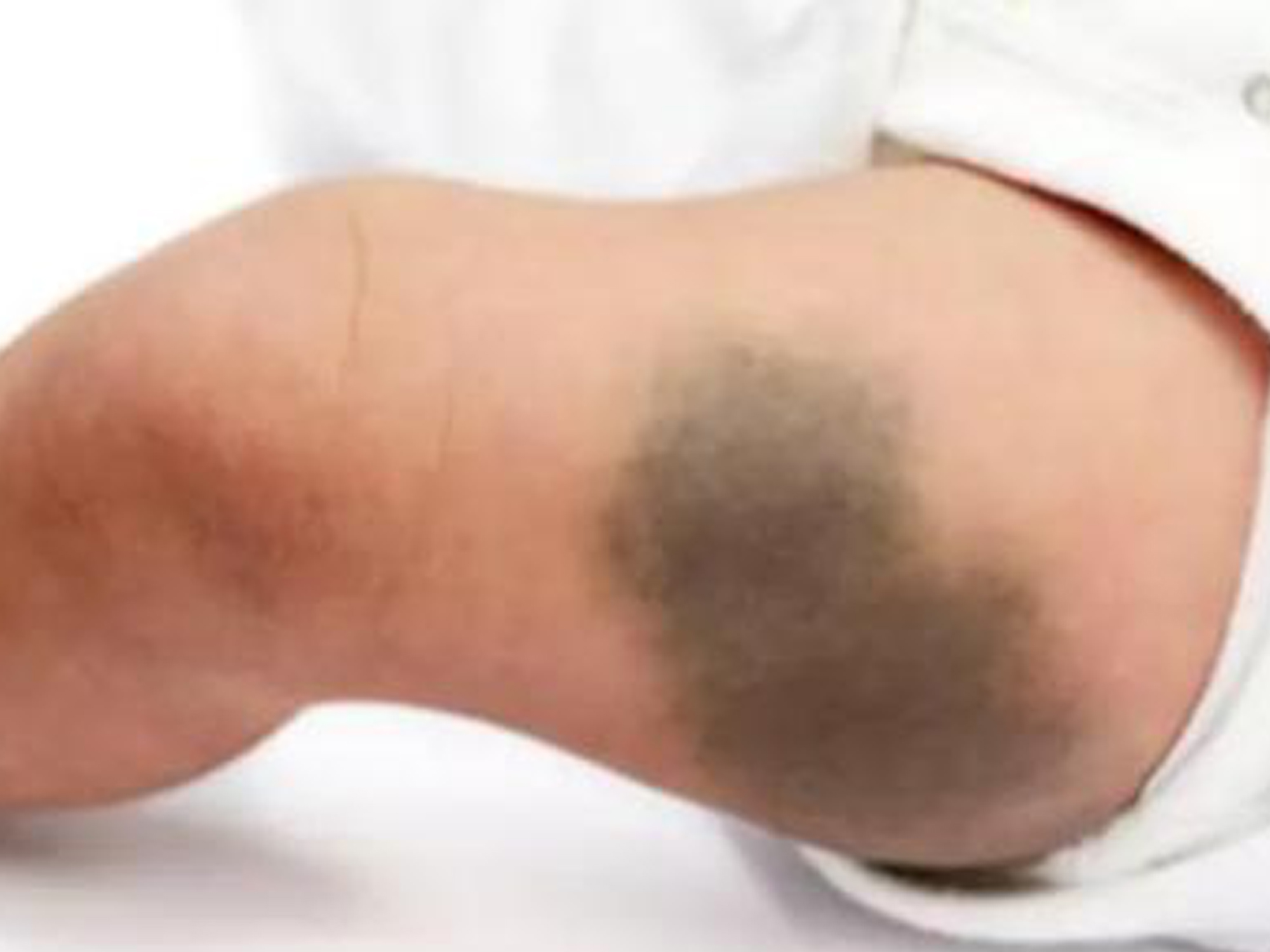 宝宝身上胎记是怎么形成的,宝宝身上的胎记一般长在哪里