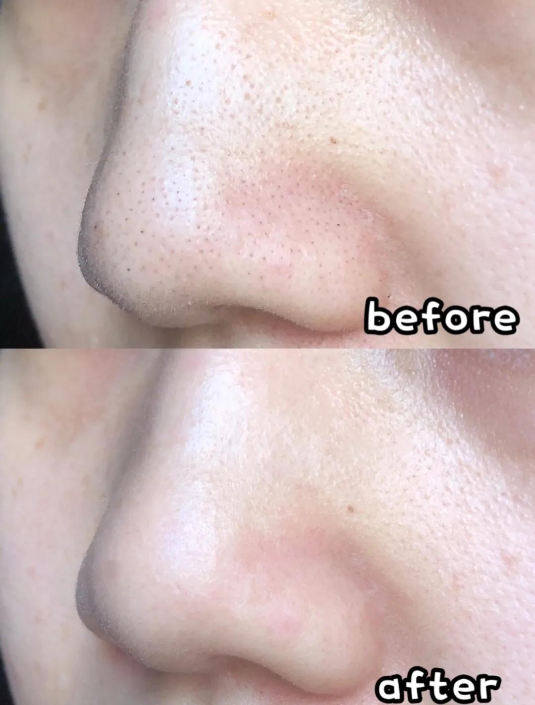 黑头闭口连根拔起,黑头粉刺连根拔起留坑