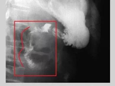 十二指肠球部溃疡解剖位置,十二指肠球部溃疡x线表现