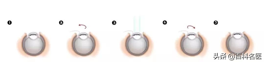 近视眼矫正的四种手术,近视眼如何通过手术矫正