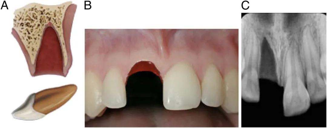 宝宝磕掉乳牙还能再长吗,宝宝磕掉牙会长出来吗