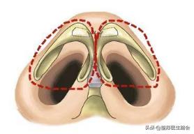 鼻头变大如何修复,鼻修复半年了鼻头变大怎么办