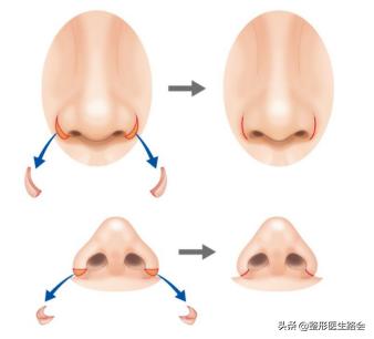 鼻翼缩小外切好吗,鼻翼缩小外切还是内切效果好