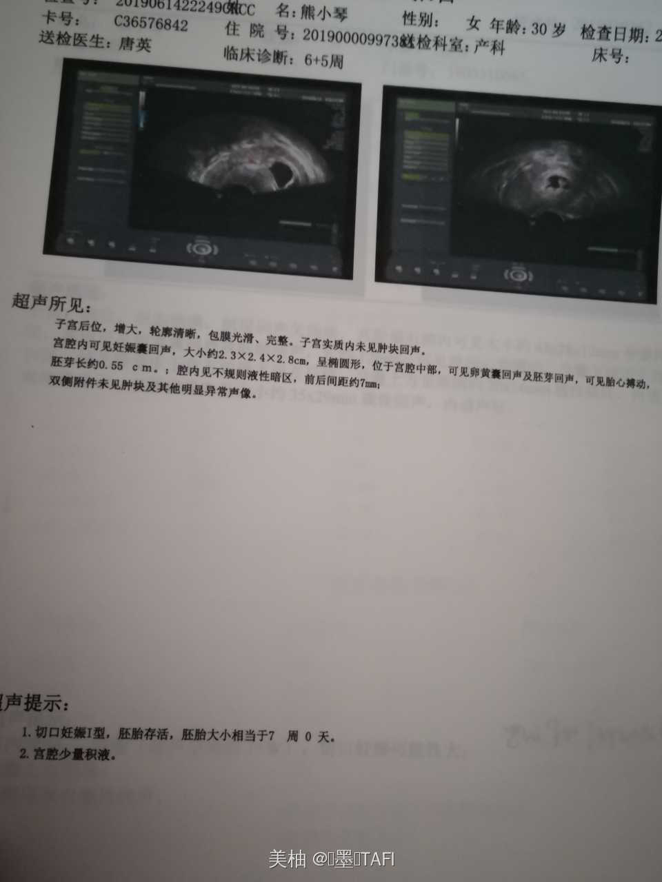 切口妊娠的治疗方法,切口妊娠人流危险吗