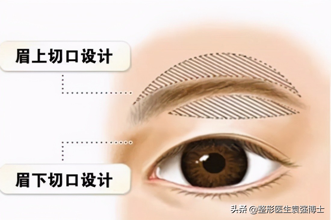 做提眉手术哪种方法效果最好,想做提眉挂什么科