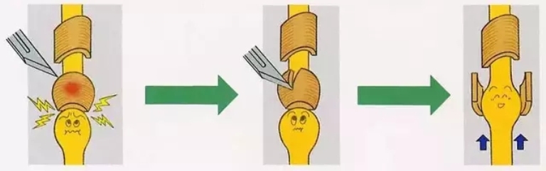 小儿狭窄性腱鞘炎应该怎么办？