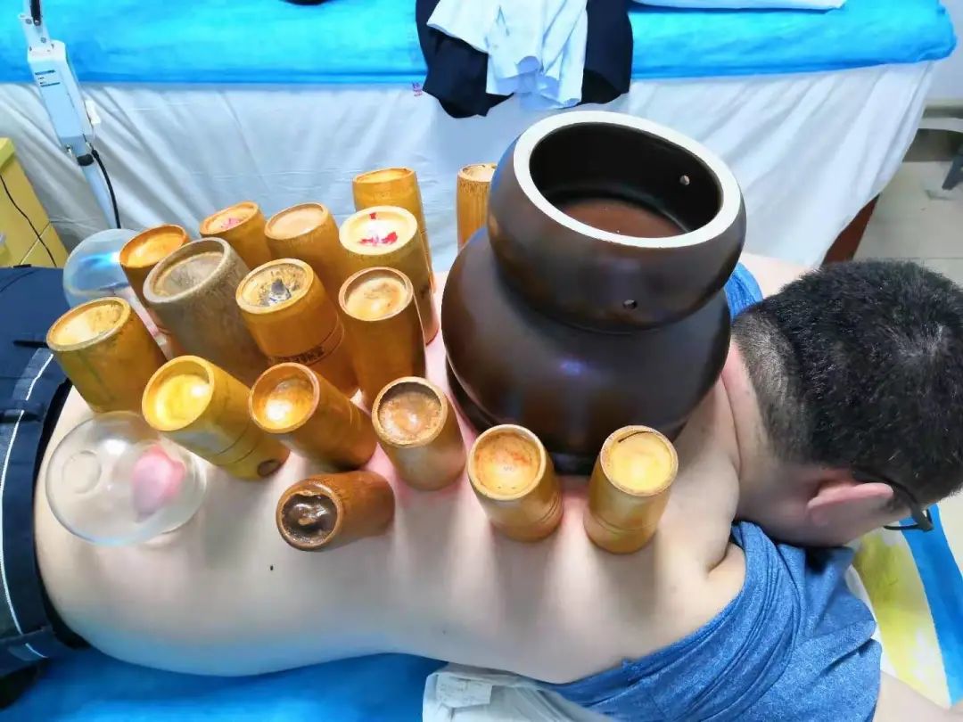 男人排湿气最快的方法拔罐祛湿气,拔罐拔哪几个穴位祛湿气效果最好