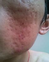 痘痘肌大作战视频教程,痘痘肌的修复