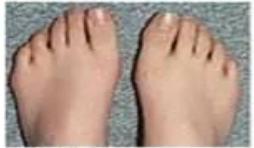 拇外翻陈医生,骨科陈医生治脚后跟疼痛