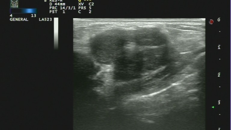 乳腺癌彩超能看出淋巴异常吗,乳腺结节和乳腺癌彩超区别