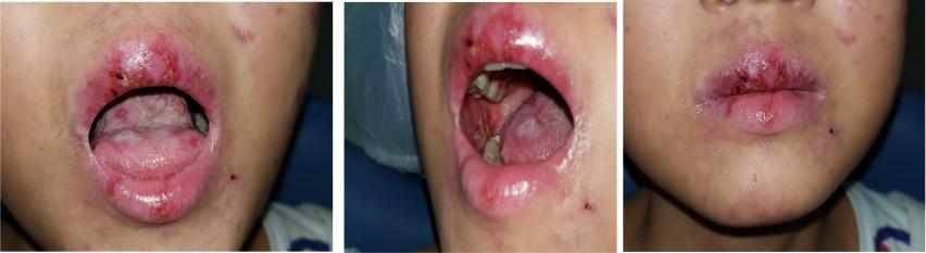 骨髓移植之后患者复发怎么办,骨髓移植后的排异反应有口腔溃疡