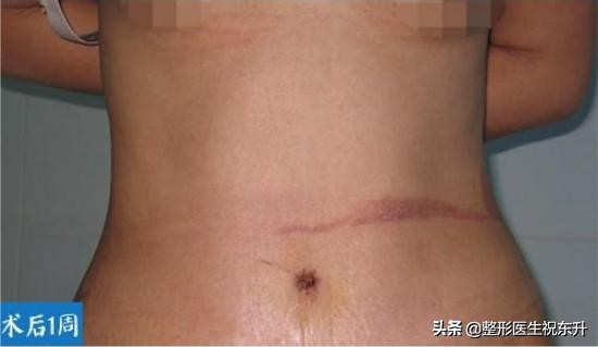 腹部腹壁整形,腹壁整形恢复后腹部图片