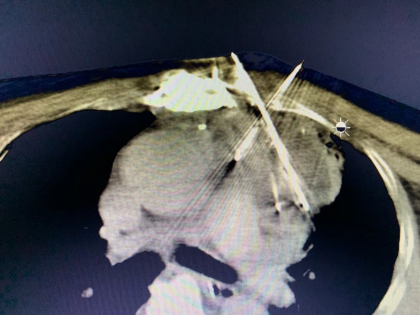 胸腺肿瘤不能手术该怎么治疗,胸腺瘤微波消融