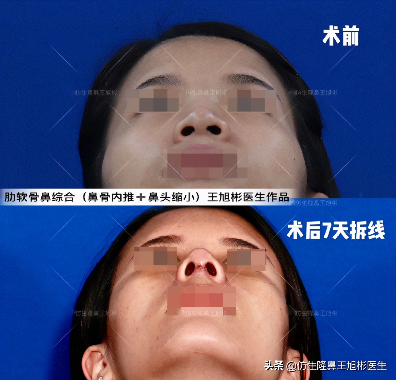 鼻头和鼻小柱是如何抬高的,鼻头扁是什么预兆