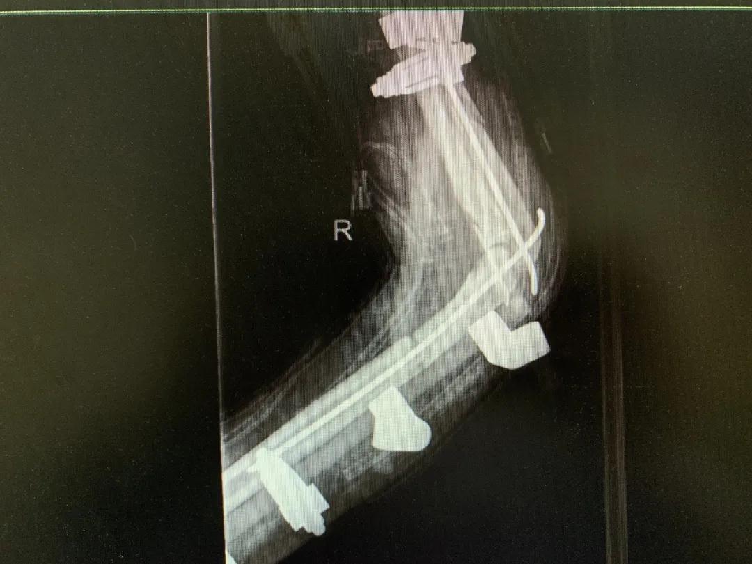 【日照市人民医院】右臂卷入机器被撕裂 6.5小时成功复活