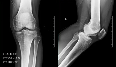 关节炎辟谣,膝关节滑膜炎辟谣