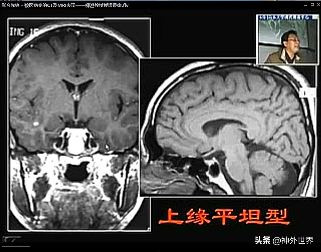 鞍区核磁解剖图,鞍区解剖与手术