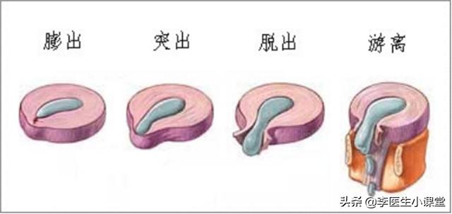 腰间盘突出的康复治疗,腰间盘突出的康复治疗有哪些