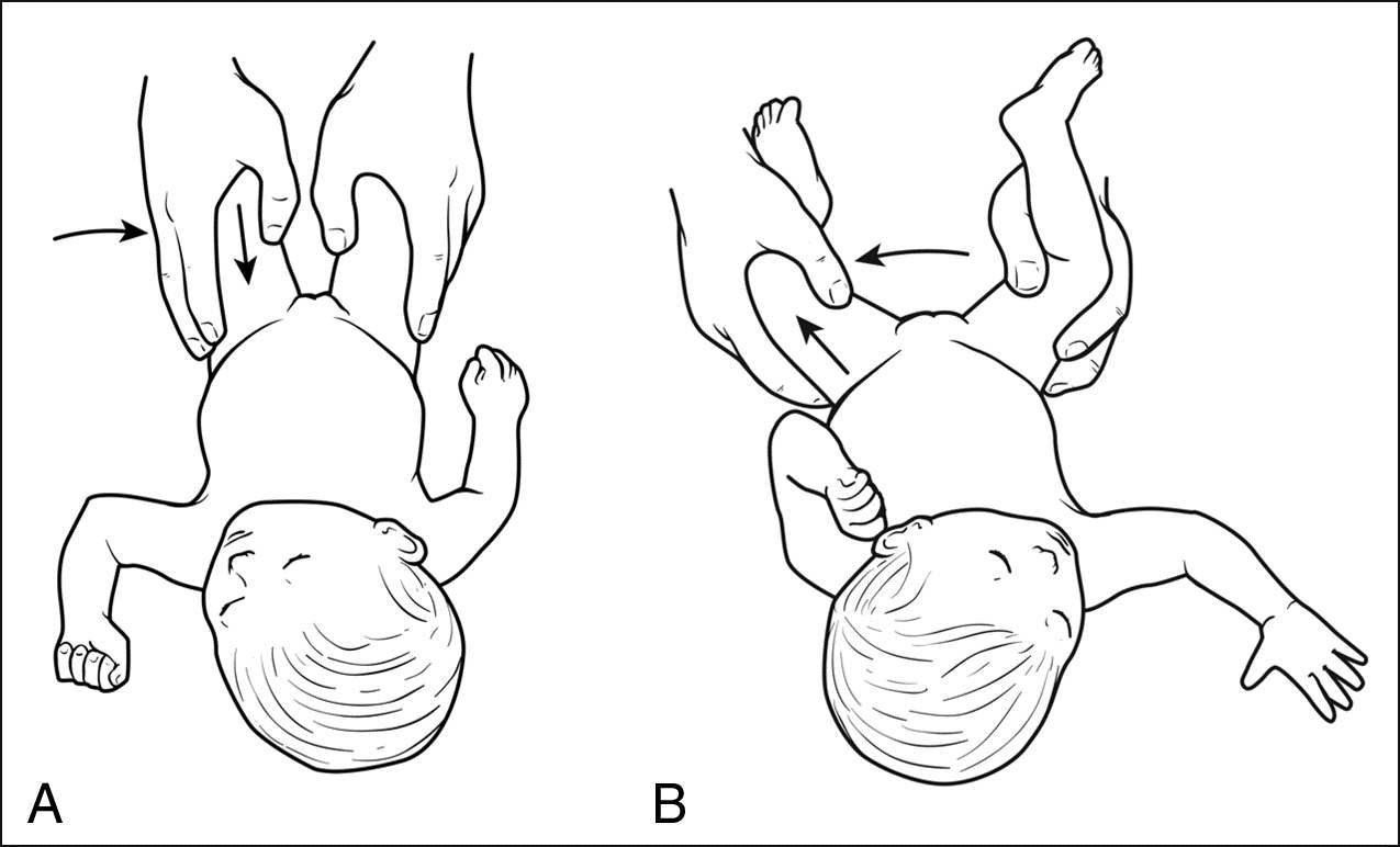 宝宝皮纹不对称腿好像粗细不一样,婴儿皮纹不对称多大治疗效果最好