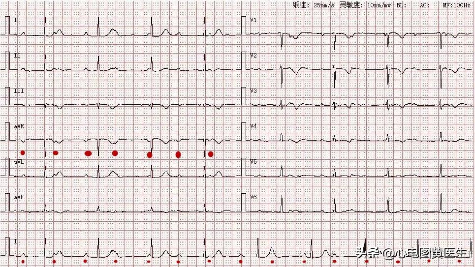 三度房室传导阻滞，房室干扰性脱节，怎么看？