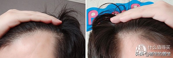 拯救发际线大作战,拯救发际线高男士