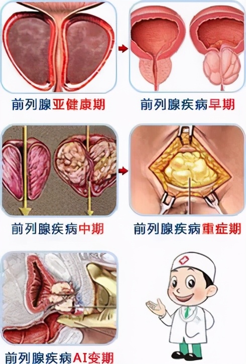 上期回顾|正视男性前列腺炎，消除性功能障碍的隐患