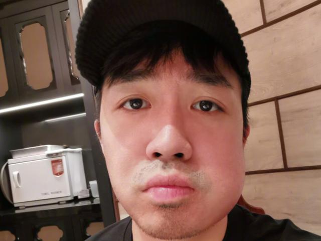 俞灏明现在脸部修复,俞灏明牙龈上火原因
