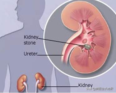 如果得了肾结石是不是必须碎石,如果得了肾结石如何治疗好