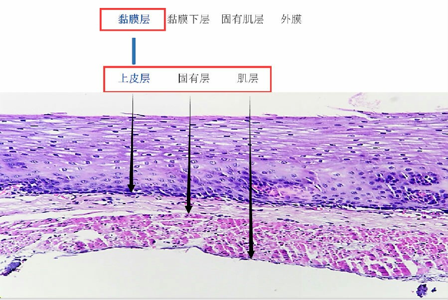 原位癌和浸润癌的区别,原位癌浸润癌区别
