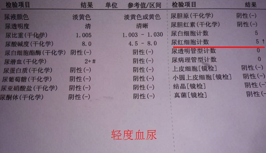 经期剧烈运动后尿血,运动后尿血是什么原因