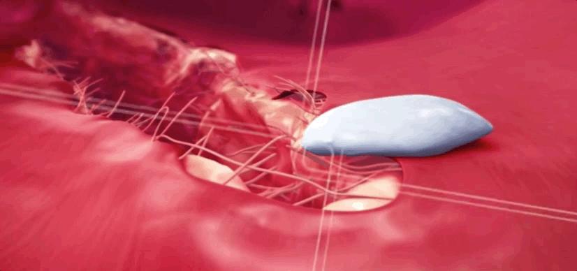 血小板破裂是什么意思,血小板凝固原因