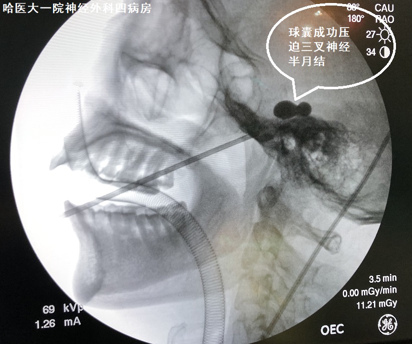机器人微创手术治疗三叉神经,智能机器人治疗三叉神经痛