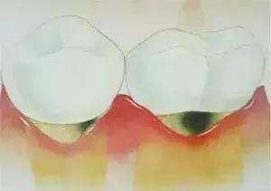 牙齿为何会变薄,牙齿为什么会牙龈萎缩