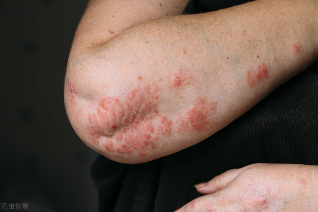 皮炎很痒的最佳外用药膏,皮炎瘙痒越挠越痒是什么原因